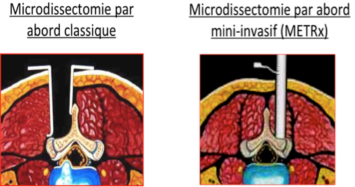 Comparaison entre abord classique et abord mini-invasif transtubulaire