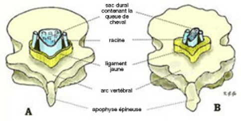 Canal lombaire normal (A) et canal lombaire rétréci (B)