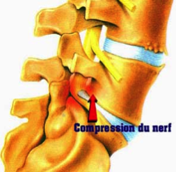 Schéma de hernie discale L5S1 comprimant le nerf sciatique